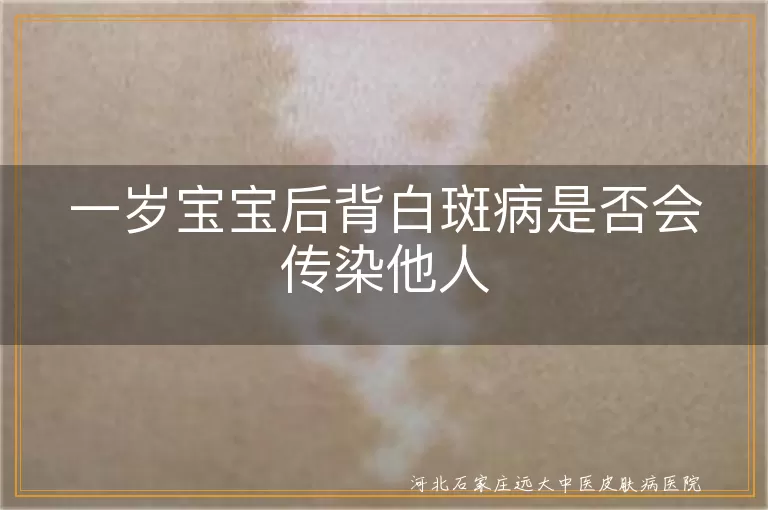 一岁宝宝白癜风传染性,儿童白斑病治疗注意,幼儿白癜风心理影响