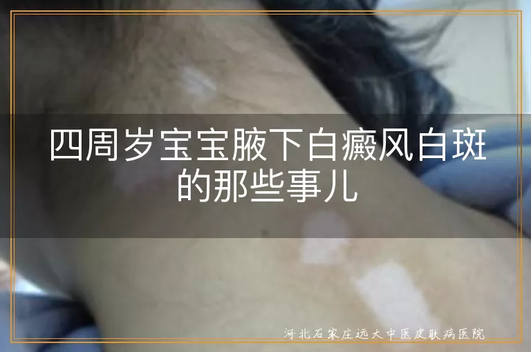 宝宝腋下白癜风遗传问题, 白癜风白斑传染误区, 四周岁宝宝白斑治疗希望