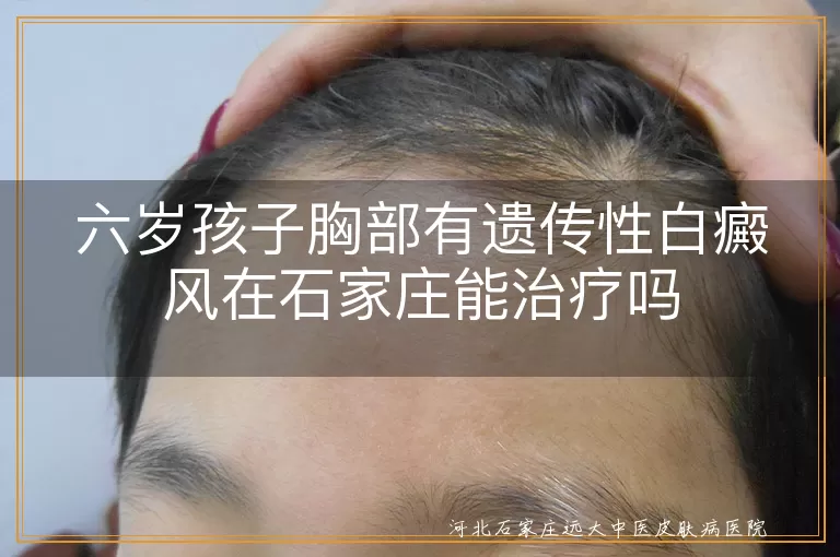 六岁孩子胸部有遗传性白癜风在石家庄能治疗吗