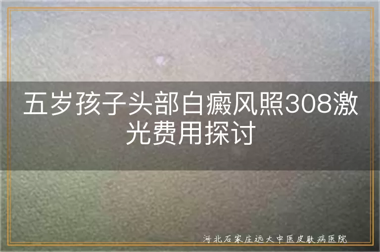 五岁孩子白癜风治疗费用, 儿童白斑308激光花费, 五岁头部白癜风照光费用