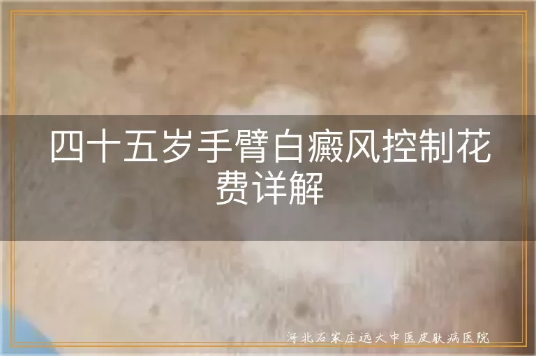 四十五岁手臂白癜风控制花费详解
