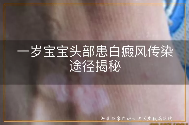 一岁宝宝白癜风传染途径,宝宝头部白斑传染问题,儿童白癜风非传染性