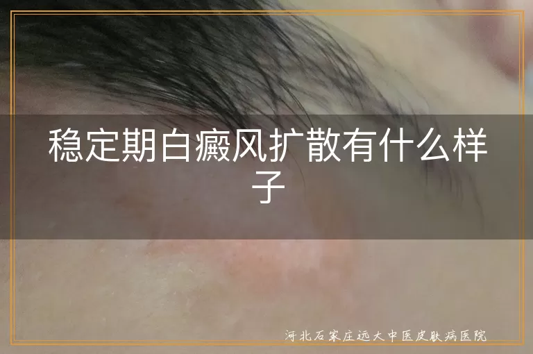 稳定期白癜风扩散表现特征,白斑稳定期扩散预警信号,白癜风稳定期扩散识别方法