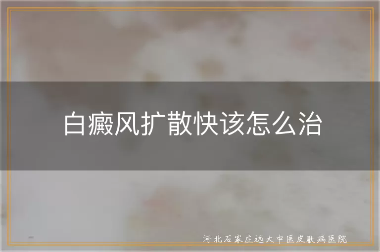 白癜风扩散期如何有效控制,白斑扩散速度快怎么应对,白癜风快速扩散的治疗方法