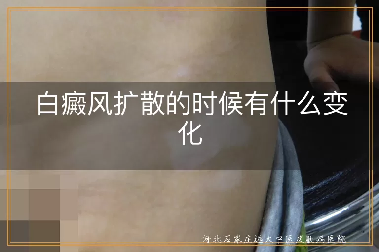 白癜风扩散阶段特征变化,白癜风进展期皮肤表现,白斑扩散时身体反应