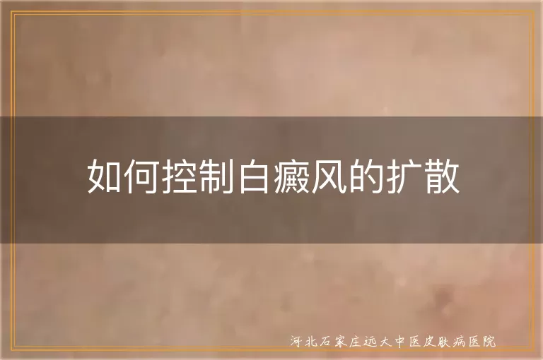 白癜风扩散预防措施,皮肤白斑如何稳定病情,白癜风扩散期的护理方法