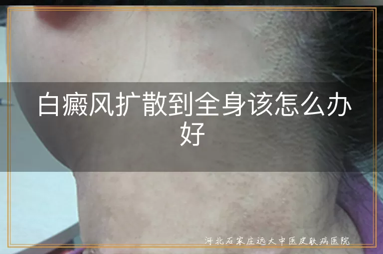 `白癜风全身管控策略,白斑蔓延调节方法,全身性白癜风照护要点`