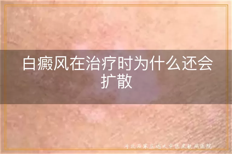 为何白斑吃药后还扩大,白癜风初期治不住长新斑,白斑治疗中继续蔓延