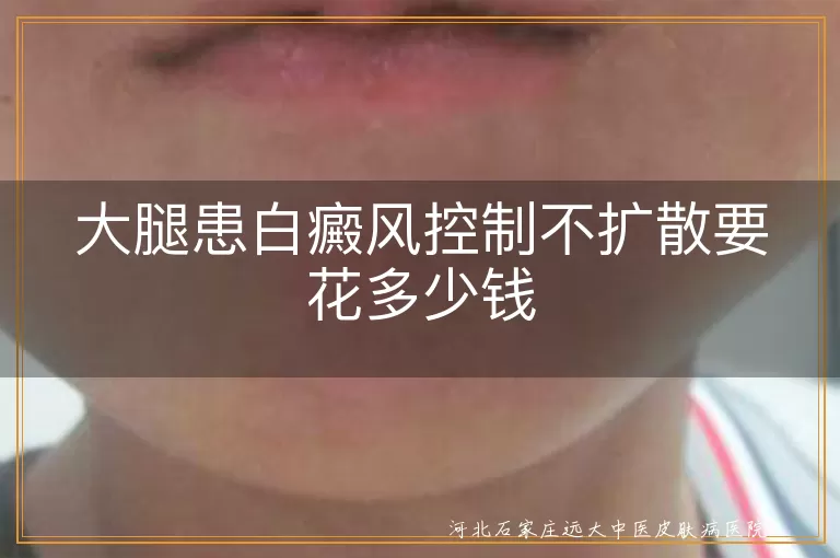 `白斑控制花费,大腿白癜风费用,白癜风不扩散开销`