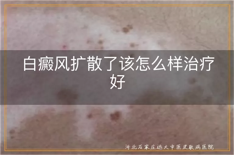 白斑快速蔓延后怎么办,白癜风控制后修复策略,白斑反复扩散的救急指南