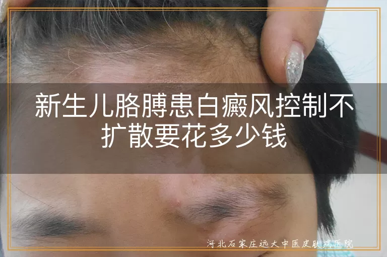 满月宝宝臂部白斑治疗费用,新生儿白癜风控制支出,婴幼儿胳膊白斑防护价