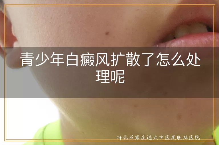 青少年白斑急剧变黑怎么办,白癜风悄然增大多快干预,学生群体白斑扩散控制方法