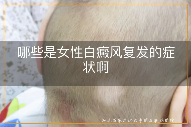 哪些是女性白癜风复发的症状啊