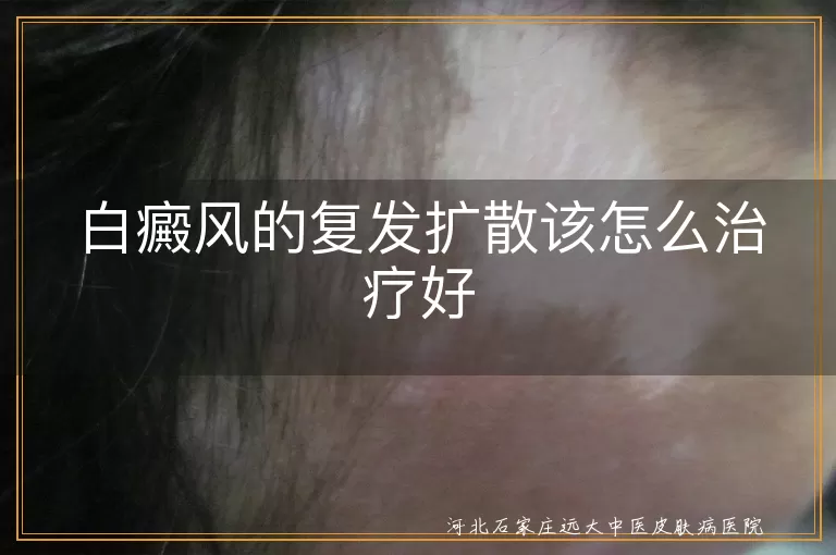 白癜风的复发扩散该怎么治疗好