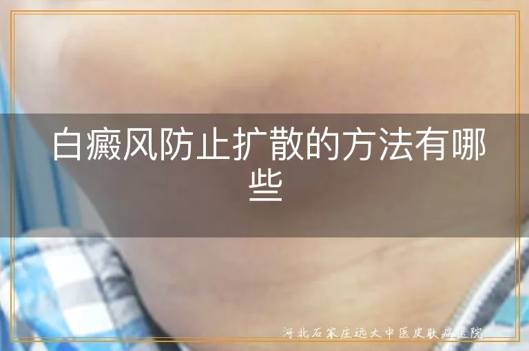 白斑日常护理全指南,白癜风患者饮食调整秘诀,白癜风心理减压妙招