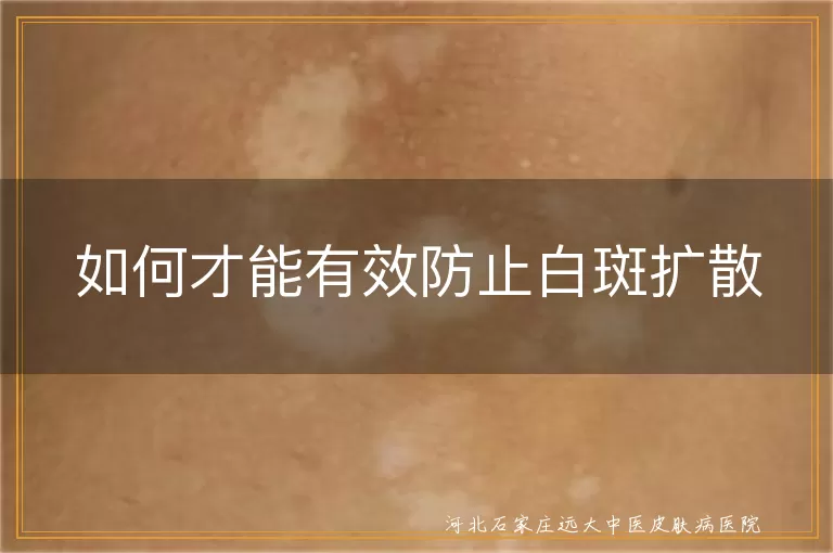 白癜风日常防扩散技巧,白斑稳定控制攻略,白癜风护理防蔓延方法