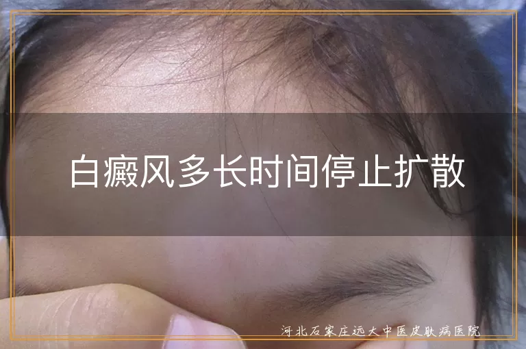 白癜风多久停止扩散,白癜风扩散控制周期,白斑多久进入稳定期