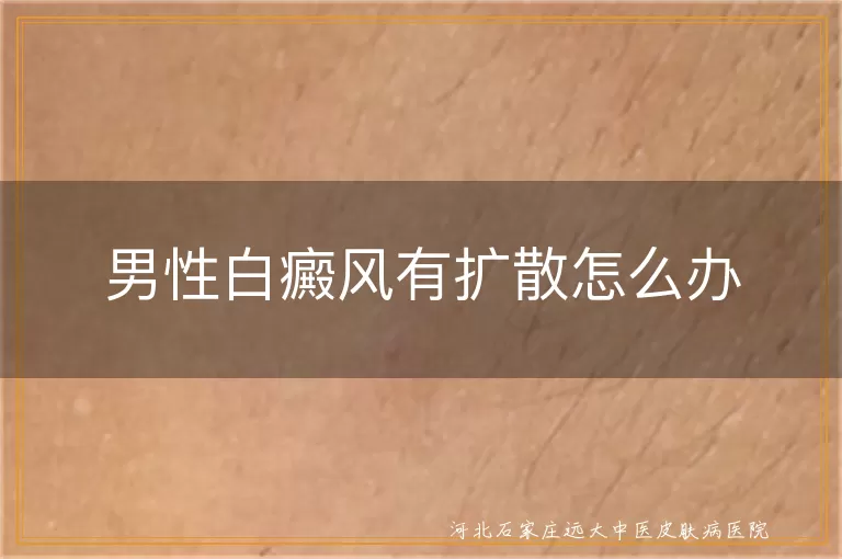 男性白癜风有扩散怎么办