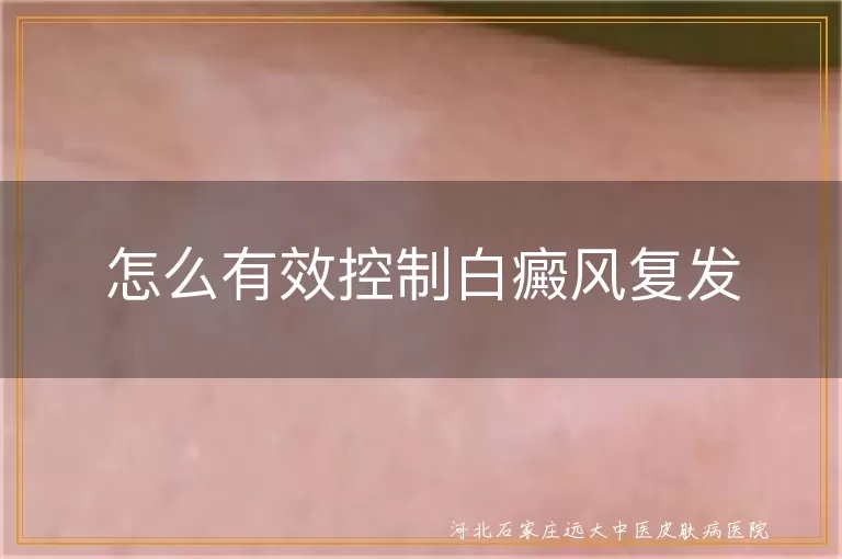 怎么有效控制白癜风复发