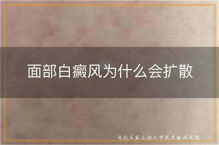 面部白癜风扩散诱因,白斑面积扩大真相,白癜风面部蔓延机制