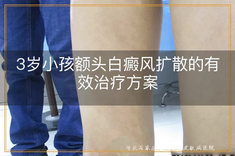 3岁小孩额头白癜风扩散的有效治疗方案