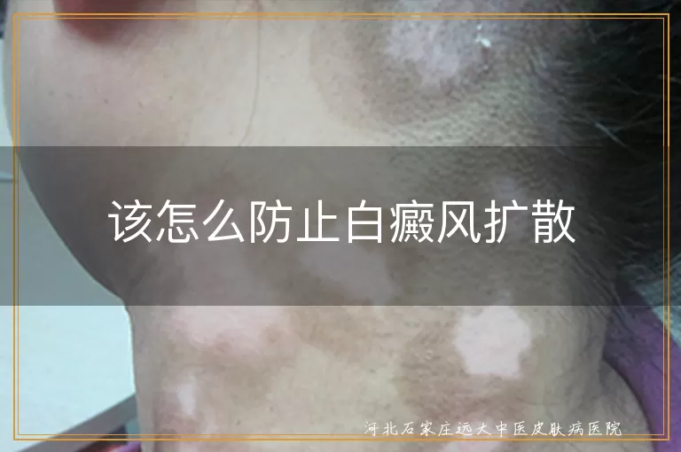 白癜风扩散如何预防,白斑病情控制方法,防止白癜风蔓延技巧