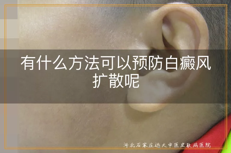 有什么方法可以预防白癜风扩散呢