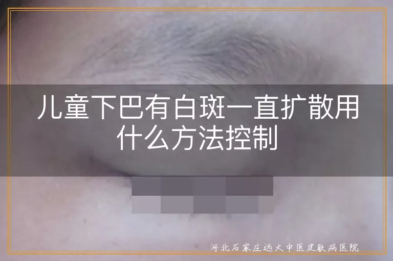 `儿童下巴白斑扩散怎么控制方法,小儿面部白癜风持续发展如何应对,孩童下颌皮肤出现白斑不断扩散咋办`