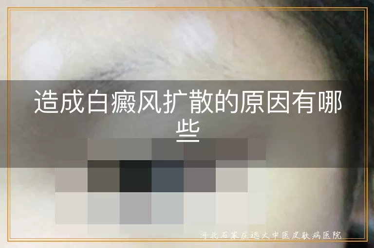 白癜风扩散的原因具体有哪些,白斑面积变大的因素是什么,导致白癜风加重的常见诱因