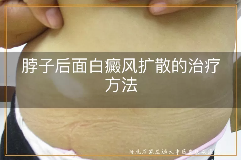 脖子后面白癜风扩散的治疗方法
