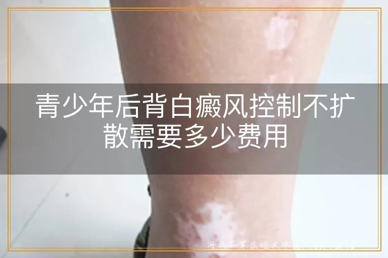 青少年后背白癜风控制不扩散需要多少费用