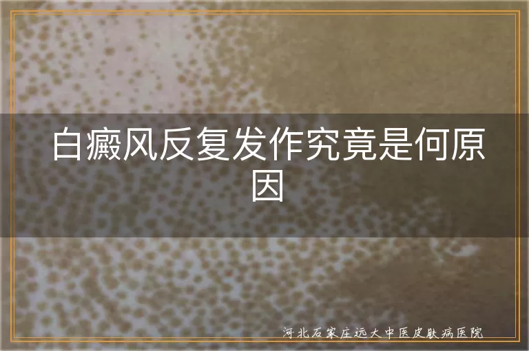 白癜风反复发作是什么原因,白斑总是复发是什么原因,白癜风反复出现是何原因