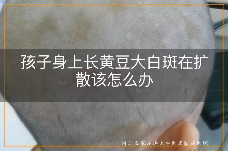 孩子皮肤白斑扩散该怎么办,儿童黄豆大白斑是白癜风吗,孩子身上白斑扩散怎么控制