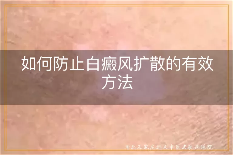 如何防止白癜风扩散的有效方法