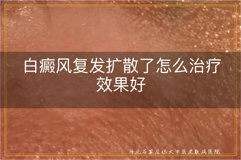 白癜风复发扩散了怎么治疗好,白斑复发扩散要如何治疗好,白癜风扩散复发了怎么治才好