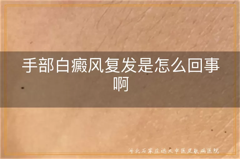 手部白癜风复发是怎么回事啊