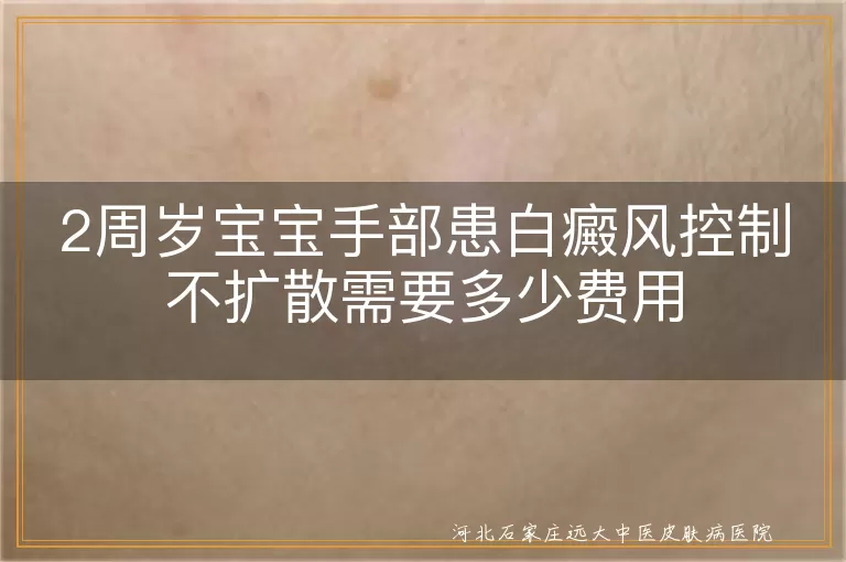 两岁宝宝手部白癜风控制费用,幼儿手部白斑治疗花费多少,宝宝手部白癜风稳定价格