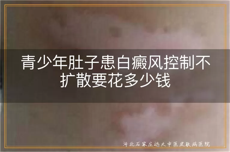 青少年腹部白癜风控制不扩散费用,肚子白斑控制不扩散要多少钱,青少年白癜风维持不发展花费咨询