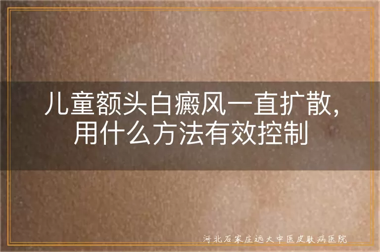 儿童额头白斑扩散如何控制,孩子额头白癜风控制办法,儿童白癜风扩散了怎么办