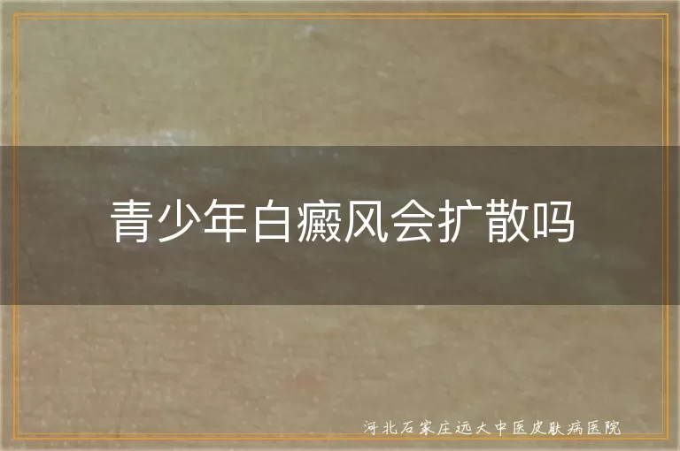 青少年白癜风会扩散吗,青少年白斑会不会扩大,青少年白癜风扩散原因