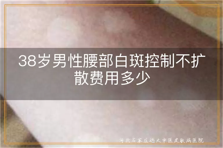 38岁男性腰部白斑控制不扩散费用多少