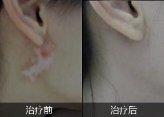 石家庄治疗白癜风偏方最好的方法是什么呢