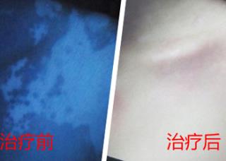 石家庄专业白癜风病院的治疗格式