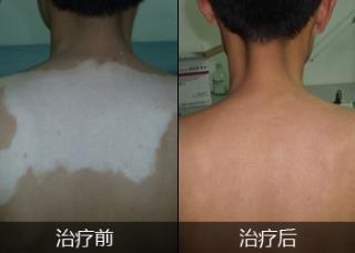 做好自我维护有效治疗白癜风