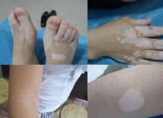 颈部白癜风应当如何停止治疗和保健