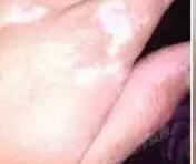 快速治疗白癜风要注重哪些效果