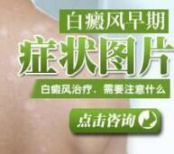 医师解说详细治疗白癜风有哪些格式