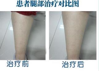 石家庄有治疗白癜风的专科病院吗