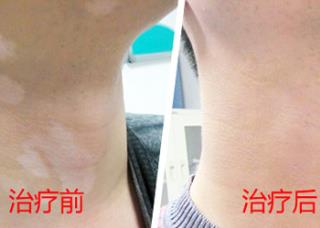 白癜风治疗效果如何区分