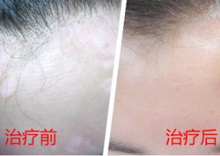 白癜风初期有什么症状白癜风初期症状会有哪些